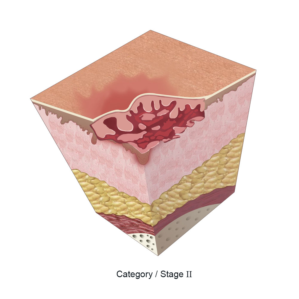 icd-10-code-for-stage-2-pressure-ulcer-medial-leg